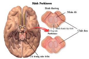 Các bệnh lý rối loạn thần kinh nguy hiểm thường gặp: parkinson, alzheimer, run vô căn…