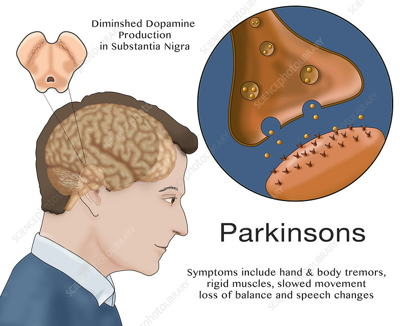 Phương pháp điều trị bệnh parkinson hiện nay