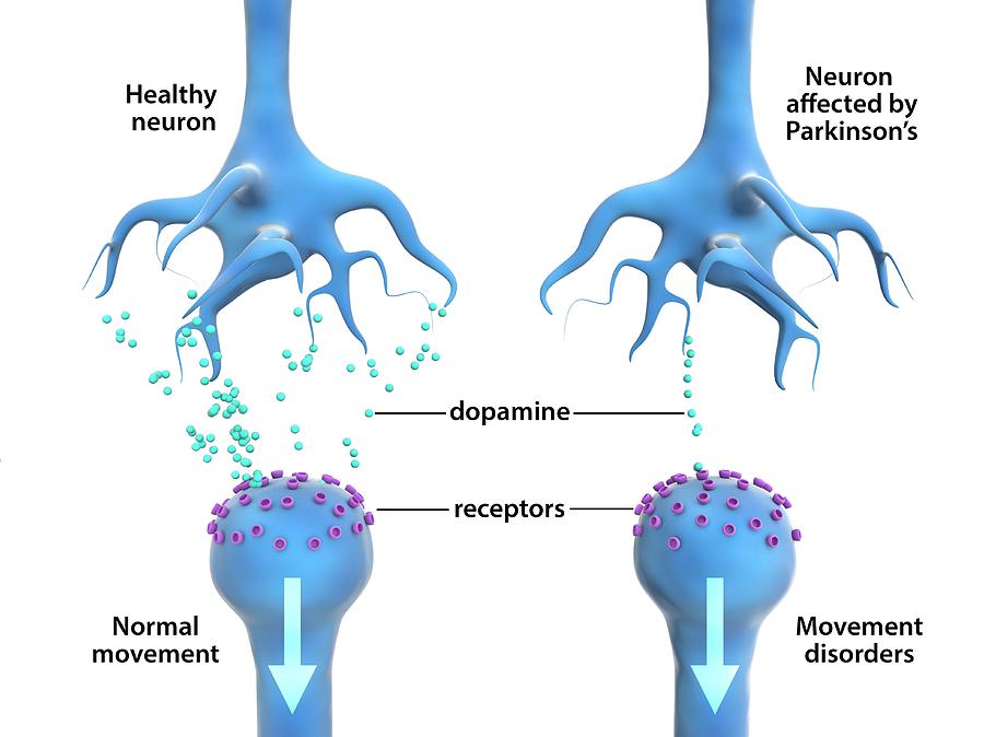 BỆNH PARKINSON CÓ NÊN ĐIỀU TRỊ PHẪU THUẬT KHÔNG HAY CẦN ĐIỀU TRỊ THEO TỪNG GIAI ĐOẠN??