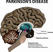 Bệnh PARKINSON: điều trị nội khoa hay ngoại khoa ra sao?