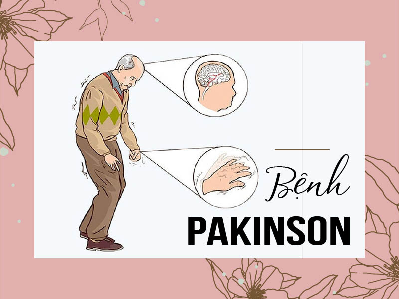 NGUYÊN NHÂN, TRIỆU CHỨNG VÀ BIẾN CHỨNG CỦA BỆNH PARKINSON CÓ NẶNG NỀ KHÔNG?