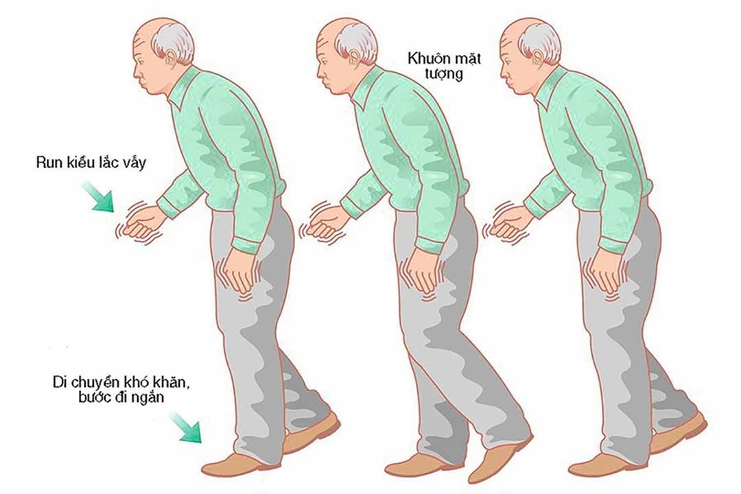 Những dấu hiệu nhỏ nhất cũng có thể mách bạn đang bị parkinson? Đừng chủ quan.