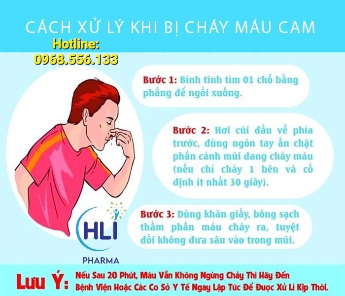 CÁC HƯỚNG ĐIỀU TRỊ CHẢY MÁU CAM