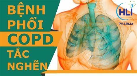 Điều Trị Đợt Cấp COPD quan trọng thế nào?
