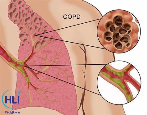 Bệnh phổi tắc nghẽn mạn tính COPD: các thể lâm sàng và điều trị.