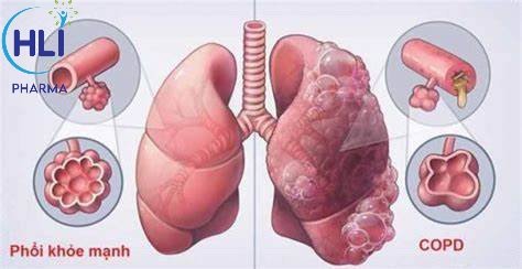 BỆNH PHỔI TẮC NGHẼN MẠN TÍNH DỄ ĐỒNG MẮC VỚI CÁC BỆNH LÝ KHÁC NÀO?