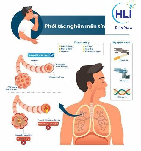 Nguyên nhân gây bệnh phổi tắc nghẽn mãn tính COPD là do đâu?