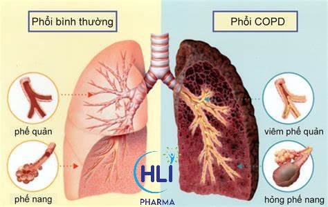 BỆNH PHỔI TẮC NGHẼN MẠN TÍNH DỄ ĐỒNG MẮC VỚI CÁC BỆNH LÝ HÔ HẤP NÀO KHÁC?