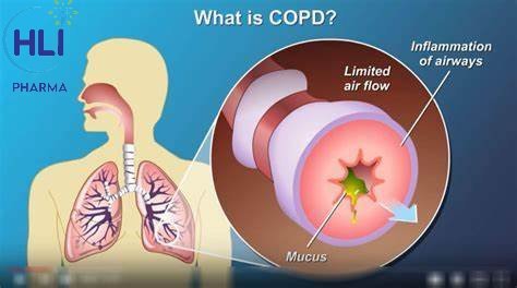 CÁCH THEO DÕI CHO BỆNH NHÂN PHỔI TẮC NGHẼN MẠN TÍNH COPD