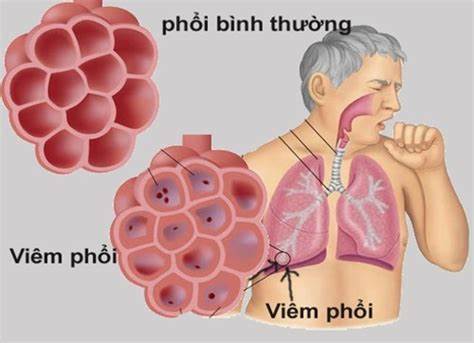 Phác đồ điều trị bệnh viêm phổi ở trẻ em