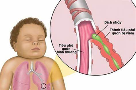 Bệnh viêm tiểu phế quản ở trẻ em là như thế nào?