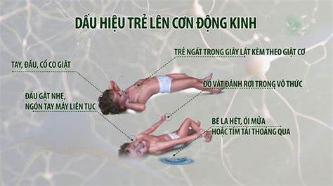 Cấp cứu cơn co giật khi có cơn động kinh – Nhất định phải biết.