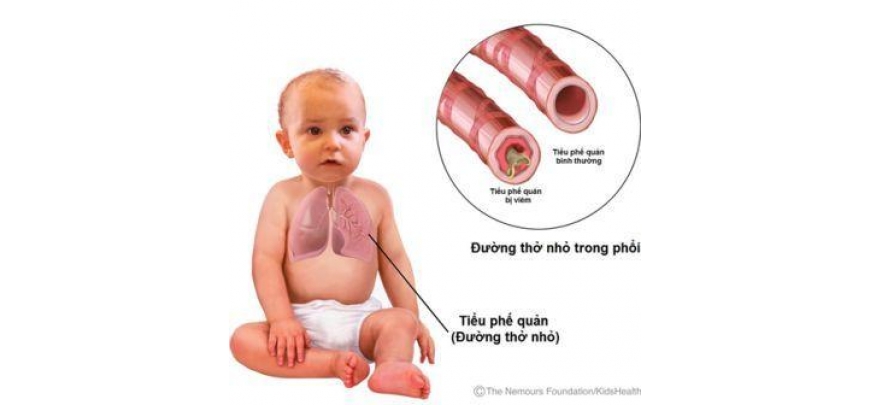 PHÁC ĐỒ ĐIỀU TRỊ VIÊM TIỂU PHẾ QUẢN Ở TRẺ EM